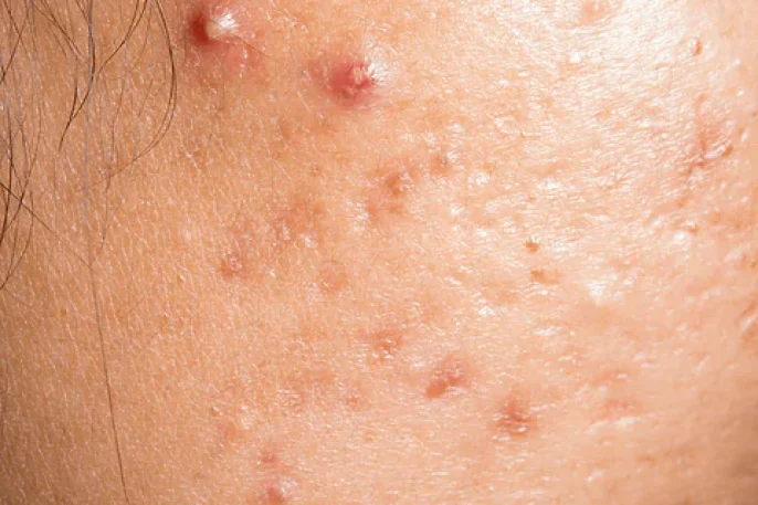 Acne-min.webp