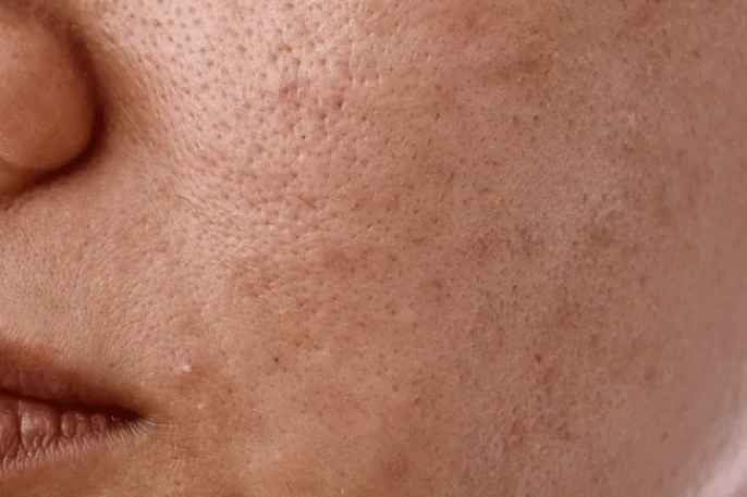 Uneven_Tone_or_Pigmentation-min.webp